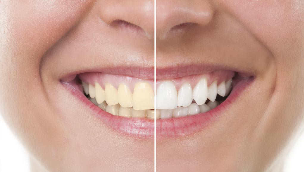 Best and Worst Teeth Whitening Products...(Reviewed) Best and Worst Teeth Whitening Products...(Reviewed)