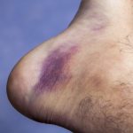 Natural Home Remedies for Bruises