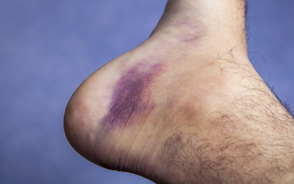 Natural Home Remedies for Bruises Natural Home Remedies for Bruises