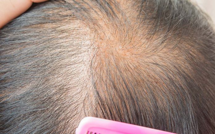Thinning-Hair-8-Ways-to-Shiny-Vibrant-Hair
