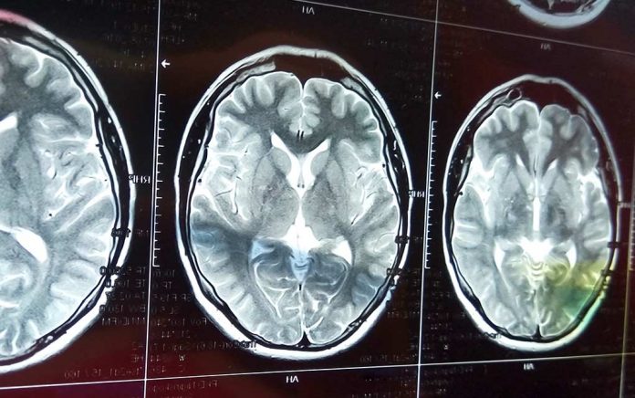 9-hidden-signs-of-stroke